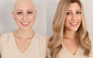 Wigs for Women with Alopecia